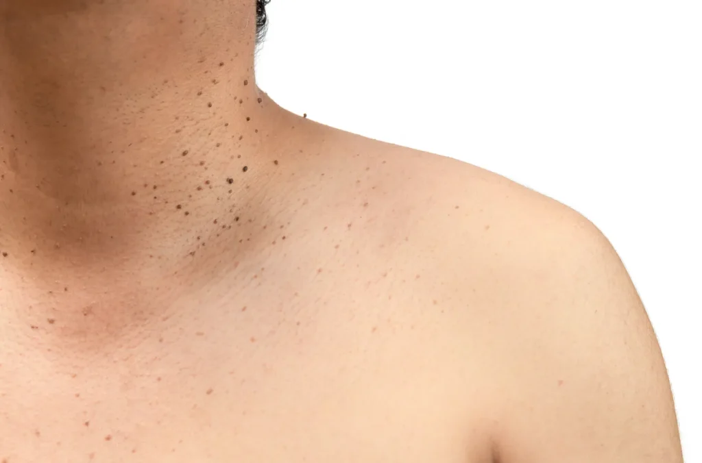 Cuello y hombro con pequeñas lesiones benignas en la piel