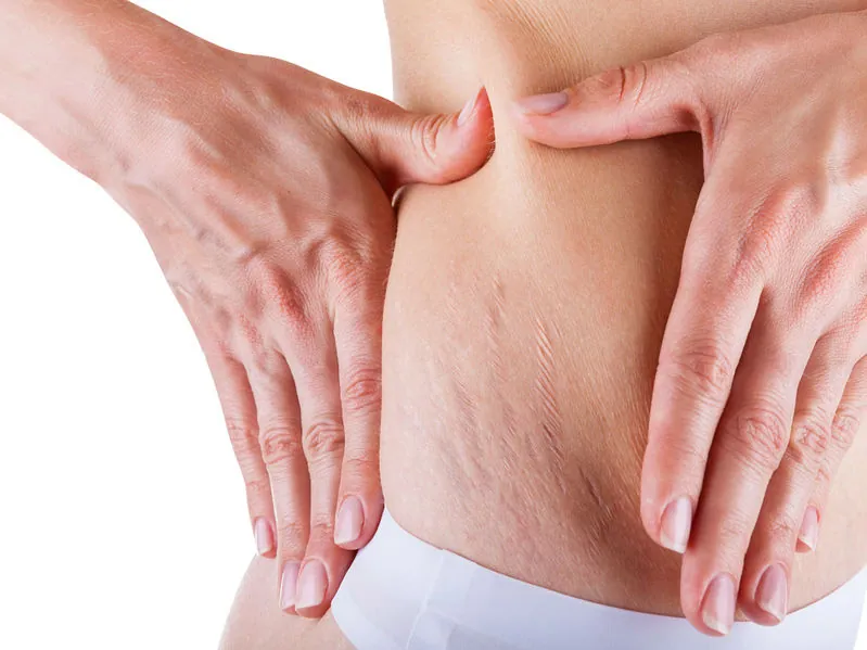 Manos sobre un abdomen con estrías