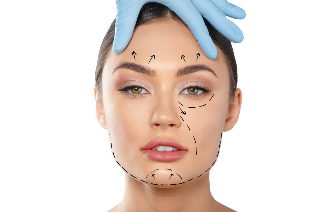 Rostro de mujer con líneas de marcado que señalan las zonas a tratar