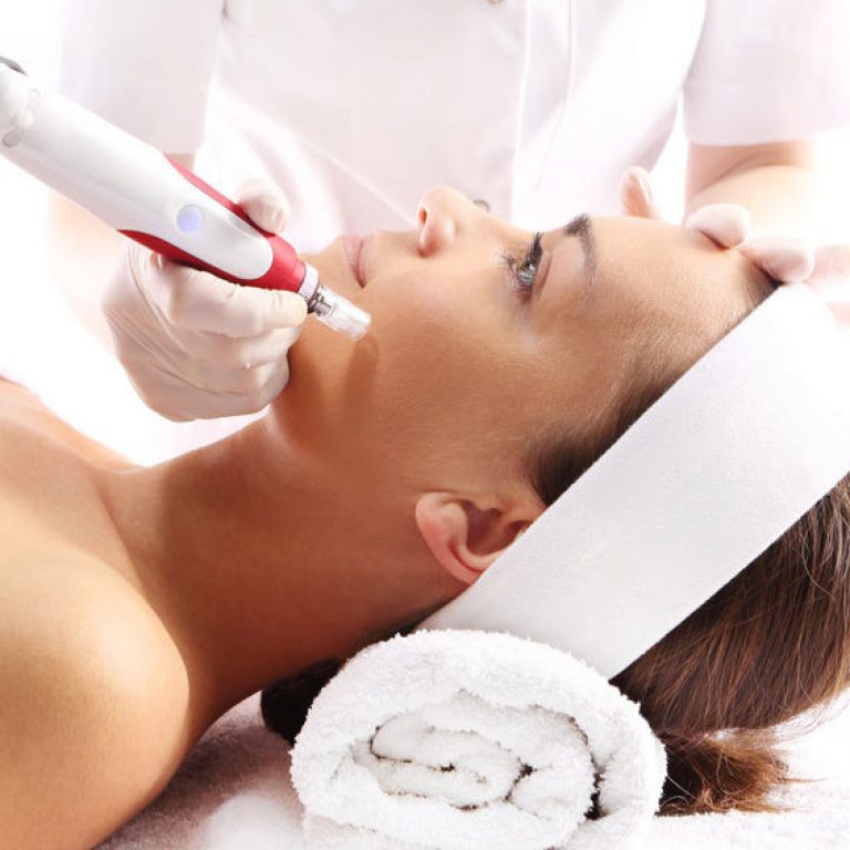 microneedling