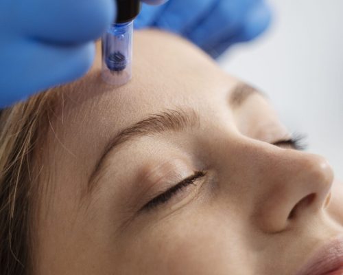 paciente-sometido-procedimiento-de-microagujas-min